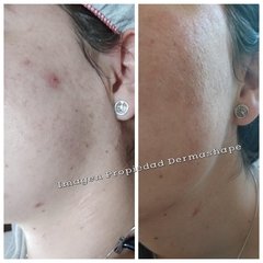 A- Tratamiento Facial Integral con extracción de puntos negros y barritos - comprar online