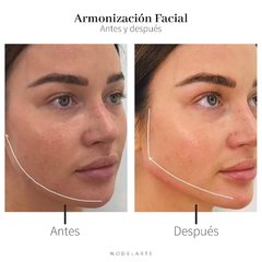 Armonización Facial con Acido Hialurónico. - comprar online