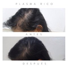 Plasma Rico en Plaquetas - Modelarte Estetica