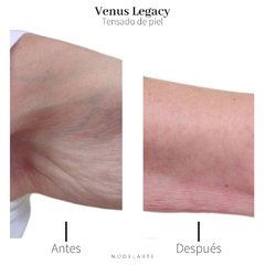Venus Legacy · 2 zonas - Modelarte Estetica