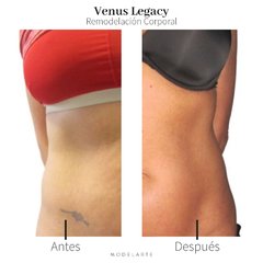 Venus Legacy · 1 Zona - Modelarte Estetica