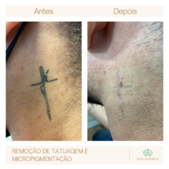 Remoção de Tatuagem e Micropigmentação