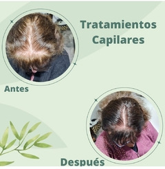 MESOTERAPIA + MASAJES CAPILARES+ ALTA FRECUENCIA