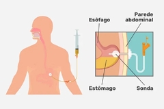 S002 - ALIMENTAÇÃO (VIA GASTROSTOMIA, SONDA NASOENTERAL)