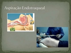 S007 - ASPIRAÇÃO ENDOTRAQUEAL