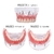 Modelo para dentaduras e próteses dentárias, dispositivo removível de uso interno para ensino de dentes com implante - loja online