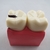 Modelo de Dentes Modelo de Comparação de Cárie Modelo de Cárie - PRODUTO IMPORTADO - loja online