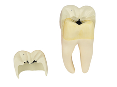 Dente Molar Inferior c/ Raiz Dupla em 3 Partes c/ Cárie, 8x o Tamanho Real Aprox. SD-5059/E - comprar online