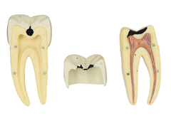 Dente Molar Inferior c/ Raiz Dupla em 3 Partes c/ Cárie, 8x o Tamanho Real Aprox. SD-5059/E na internet