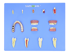 Modelo de Patologias Dentárias c/ 12 Partes em Placa SD-5059/L