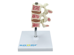 Modelo de Osteoporose SD-5200