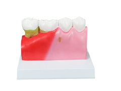 Modelo de Patologias Dentárias SD-5202 - Mix Anatomy - Simuladores e Modelos Anatômicos