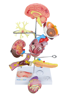Modelo de Órgãos Afetados pela Diabetes em 11 partes SD-5213
