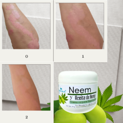 Crema de Neem y Aceite de Hemp para psoriasis y eczema - comprar en línea