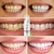 Mousse de Clareamento Dental para Limpeza de Dentes Remove Manchas Essência de Higiene Bucal na internet