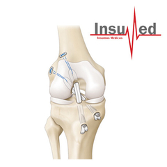 Reconstruccion Ligamentaria