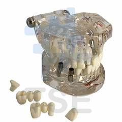 Modelo dental nervio implantado de patología transparente