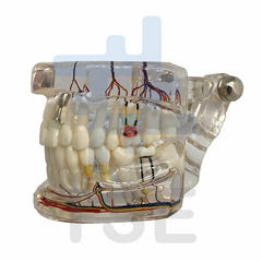 Modelo dental nervio implantado de patología transparente
