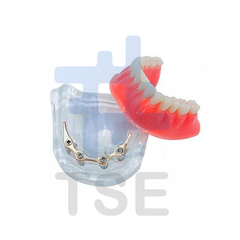 implantes dentales all on 4 precios