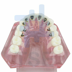 modelo dental de restauracion lingual 
