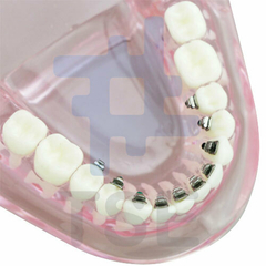 Modelo de dientes con soportes linguales de metal