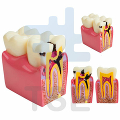 Modelo de dientes de caries dentales