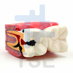Modelo de dientes de caries dentales