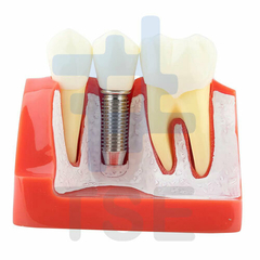 modelo dental caries