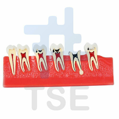 modelo dental de caries de periodoncia