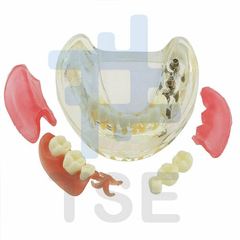 modelo de implantes dentales