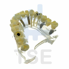 implantes mandíbula inferior