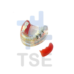 implantes mandíbula inferior