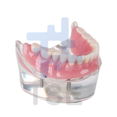 modelos de estudio para implantes dentales