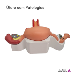 Uterus with Pathologies - Clistore