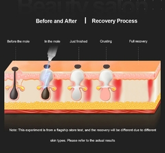 Pluma Láser de Plasma para Eliminar Marcas de la Piel y Pecas en internet