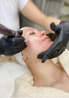 HIGIENE FACIAL+DERMAPLANING +DERMAPEN