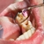 Endodoncia premolar