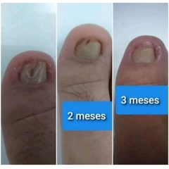 Base Para Unhas Com Micose 10ML Tratamento E Fortalecimento na internet