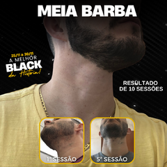 Pacote Depilação a Laser - 10 sessões Meia Barba