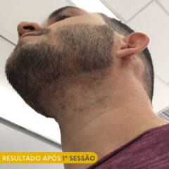 Pacote Depilação a Laser - 10 sessões Meia Barba - comprar online