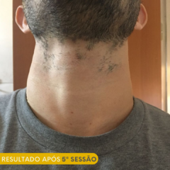 Pacote Depilação a Laser - 10 sessões Meia Barba na internet