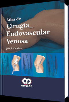 Atlas de Cirugía Endovascular Venosa - Almeida