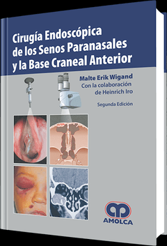 Cirugía Endoscópica de los Senos Paranasales y la Base Craneal Anterior