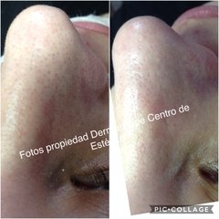 G- Tratamiento para Acné , Brotes y Puntos Rojos. - limpieza de cutis con puntos negros y tratamientos  a domicilio en buenos aires