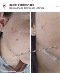 A- Tratamiento Facial Integral con extracción de puntos negros y barritos en internet